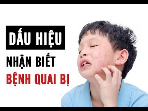TUYÊN TRUYỀN BỆNH QUAI BỊ