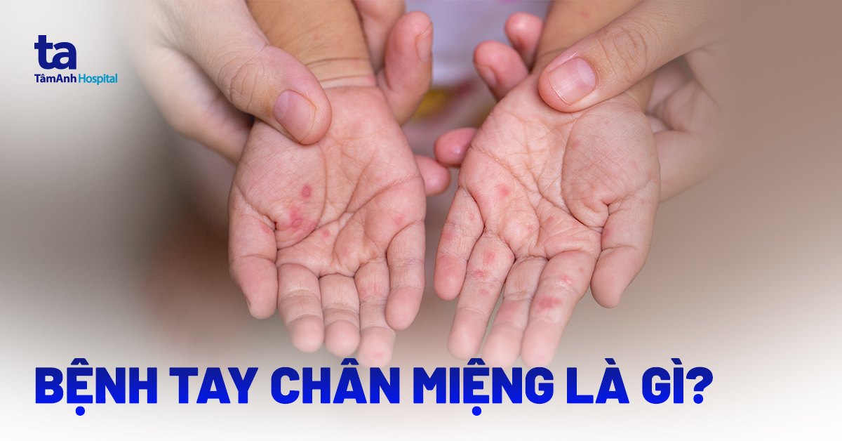 TÌM HIỂU VỀ BỆNH TAY CHÂN MIỆNG