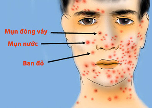 Hinh-anh-benh-thuy-dau-o-nguoi-lon-voi-nhung-ban-do-mun-nuoc-va-len-vay